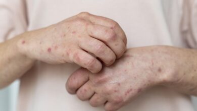 Cakupan Imunisasi Belum Aman, BPOM Percepat Vaksin MMR di Tengah 10 Kematian Campak